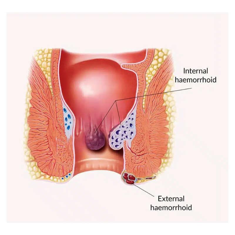 Piles (Hemorrhoid)