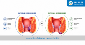 internal vs external hemrrhoids